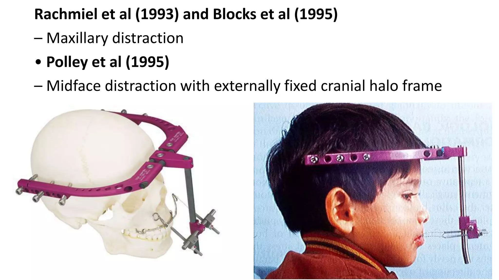 Distraction osteogenesis in orthodontics -Dr.G V SHETTY | PPTX