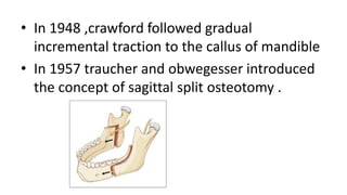 Distraction osteogenesis in orthodontics -Dr.G V SHETTY | PPTX