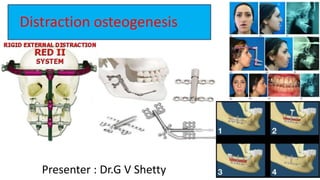 Distraction osteogenesis
Presenter : Dr.G V Shetty
 