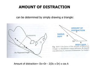 Distraction Osteogenesis of Facial bones | PPT