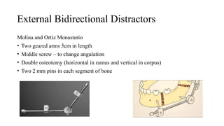 Right Pin Distractor Distraction Osteogenesis new orthodontics.pptx