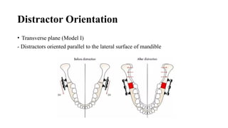 Distraction Osteogenesis new orthodontics.pptx