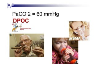 PaCO 2 = 60 mmHg
 