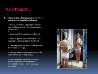 Sintomas:Os portadores desta doença apresentam um ou mais sintomas dos abaixo indicados:-» Recusa em manter o peso corporal num nível igual ou acima do mínimo adequado à idade e altura; 0-» Negação do baixo peso corporal actual;-» Medo de ganhar peso mesmo que a sua massa corporal esteja abaixo do normal;-» Visão negativa e distorcida do seu peso ou da forma do seu corpo;-» Amenorreia (ausência de pelo menos três ciclos menstruais consecutivos);-» Alguns doentes manifestam sintomas depressivos como isolamento social, irritabilidade, insónia e interesse sexual diminuído