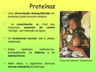 Proteínas
•   Uma alimentação desequilibrada em
    proteínas pode provocar atrasos:

•     no crescimento, ao nível dos
    músculos,      aumento     do    ventre
    “barriga”, por retenção de água,

•   no rendimento escolar, isto é, atraso
    intelectual.

•   Estas      carências   verificam-se,
    principalmente, na Infância e na
    adolescência.
                                              “Fome de Proteínas” -Kwashiorkor
•   Além disso, o organismo torna-se
    menos resistente às doenças.
 