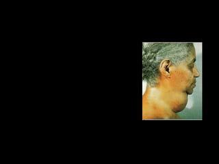 Uma alimentação escassa em minerais pode
provocar:

• Anemia: falta de ferro, que origina a
  diminuição de glóbulos vermelhos no
  sangue,

• Descalcificação nos ossos e nos dentes:
  falta de cálcio,

• Desidratação e fraqueza muscular: falta
  de sódio,
                                            •Bócio: falta de iodo
• Cárie dentária: falta de flúor,
 