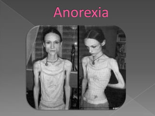 Distúrbios Alimentares