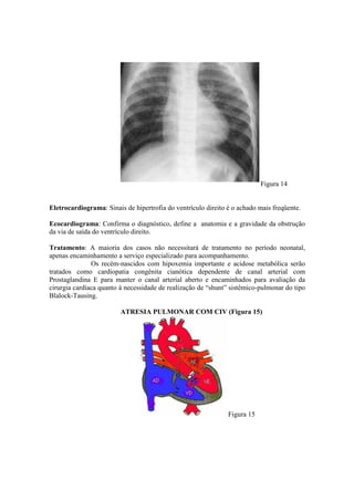 Figura 14


Eletrocardiograma: Sinais de hipertrofia do ventrículo direito é o achado mais freqüente.

Ecocardiograma: Confirma o diagnóstico, define a anatomia e a gravidade da obstrução
da via de saída do ventrículo direito.

Tratamento: A maioria dos casos não necessitará de tratamento no período neonatal,
apenas encaminhamento a serviço especializado para acompanhamento.
               Os recém-nascidos com hipoxemia importante e acidose metabólica serão
tratados como cardiopatia congênita cianótica dependente de canal arterial com
Prostaglandina E para manter o canal arterial aberto e encaminhados para avaliação da
cirurgia cardíaca quanto à necessidade de realização de “shunt” sistêmico-pulmonar do tipo
Blalock-Tausing.

                         ATRESIA PULMONAR COM CIV (Figura 15)




                                                               Figura 15
 