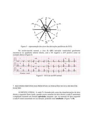 Figura 5 – representação dos eixos das derivações periféricas do ECG.

       No recém-nascido normal, o eixo do QRS (ativação ventricular) geralmente
encontra-se no quadrante inferior direito, com o D1 negativo e aVF positivo como no
exemplo abaixo (Figura 6)




                              Figura 6 – ECG de um RN normal.




7. RECONHECIMENTOS DAS PRINCIPAIS ALTERAÇÕES NO ECG DO RECÉM-
NASCIDO

        AUMENTO ATRIAL: A onda P é formada pela soma das despolarizações do átrio
direito e esquerdo Deste modo, quando ocorre aumento do átrio direito à onda P aumentará
a amplitude tomando um formato apiculado, enquanto que no aumento do átrio esquerdo
a onda P estará aumentada em sua duração, podendo estar entalhada (Figura 7 e 8).
 