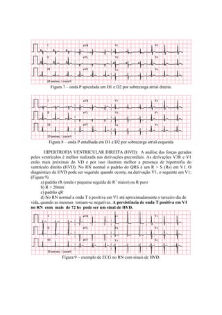 Figura 7 – onda P apiculada em D1 e D2 por sobrecarga atrial direita.




         Figura 8 – onda P entalhada em D1 e D2 por sobrecarga atrial esquerda

        HIPERTROFIA VENTRICULAR DIREITA (HVD): A análise das forças geradas
pelos ventrículos é melhor realizada nas derivações precordiais. As derivações V3R e V1
estão mais próximas do VD e por isso ilustram melhor a presença de hipertrofia do
ventrículo direito (HVD). No RN normal o padrão do QRS é um R > S (Rs) em V1. O
diagnóstico de HVD pode ser sugerido quando ocorre, na derivação V1, o seguinte em V1:
(Figura 9)
      a) padrão rR (onda r pequena seguida de R’ maior) ou R puro
      b) R > 20mm
      c) padrão qR
      d) No RN normal a onda T é positiva em V1 até aproximadamente o terceiro dia de
vida, quando as mesmas tornam-se negativas. A persistência de onda T positiva em V1
no RN com mais de 72 hs pode ser um sinal de HVD.




                Figura 9 – exemplo de ECG no RN com sinais de HVD.
 