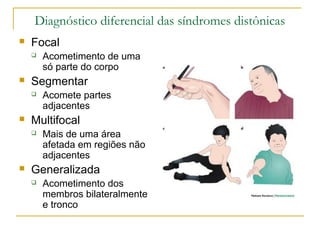 Diagnóstico diferencial das síndromes distônicas 
 Focal 
 Acometimento de uma 
só parte do corpo 
 Segmentar 
 Acomete partes 
adjacentes 
 Multifocal 
 Mais de uma área 
afetada em regiões não 
adjacentes 
 Generalizada 
 Acometimento dos 
membros bilateralmente 
e tronco 
 
