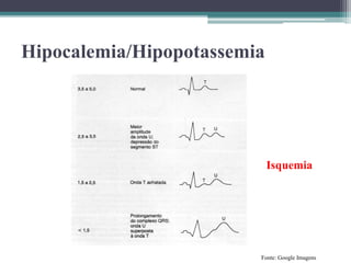 Hipocalemia/Hipopotassemia
Fonte: Google Imagens
Isquemia
 