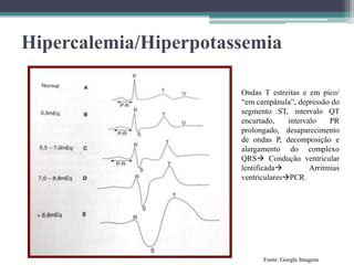 Hipercalemia/Hiperpotassemia
Fonte: Google Imagens
Ondas T estreitas e em pico/
“em campânula”, depressão do
segmento ST, intervalo QT
encurtado, intervalo PR
prolongado, desaparecimento
de ondas P, decomposição e
alargamento do complexo
QRS Condução ventricular
lentificada Arritmias
ventricularesPCR.
 