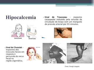 Hipocalcemia
Fonte: Google imagens
 