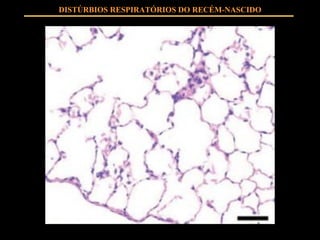 DISTÚRBIOS RESPIRATÓRIOS DO RECÉM-NASCIDO 