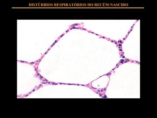 DISTÚRBIOS RESPIRATÓRIOS DO RECÉM-NASCIDO 