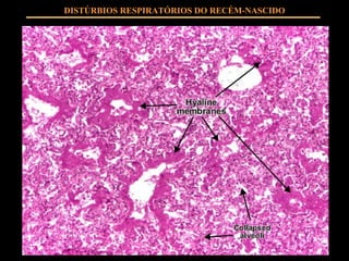 DISTÚRBIOS RESPIRATÓRIOS DO RECÉM-NASCIDO 