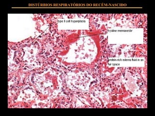 DISTÚRBIOS RESPIRATÓRIOS DO RECÉM-NASCIDO 