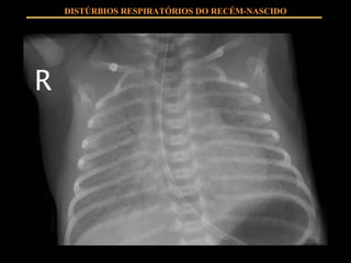 DISTÚRBIOS RESPIRATÓRIOS DO RECÉM-NASCIDO 