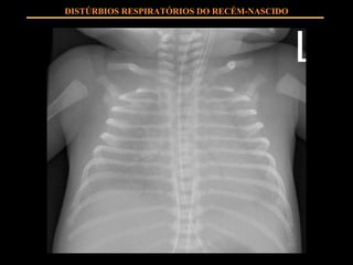 DISTÚRBIOS RESPIRATÓRIOS DO RECÉM-NASCIDO 