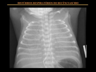 DISTÚRBIOS RESPIRATÓRIOS DO RECÉM-NASCIDO 
