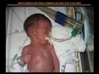 DISTÚRBIOS RESPIRATÓRIOS DO RECÉM-NASCIDO 