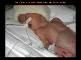 DISTÚRBIOS RESPIRATÓRIOS DO RECÉM-NASCIDO 