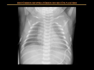 DISTÚRBIOS RESPIRATÓRIOS DO RECÉM-NASCIDO 