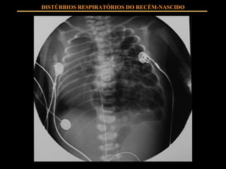 DISTÚRBIOS RESPIRATÓRIOS DO RECÉM-NASCIDO 