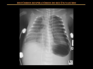DISTÚRBIOS RESPIRATÓRIOS DO RECÉM-NASCIDO 