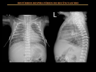 DISTÚRBIOS RESPIRATÓRIOS DO RECÉM-NASCIDO 