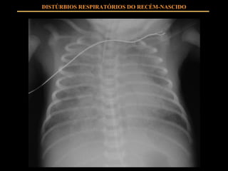 DISTÚRBIOS RESPIRATÓRIOS DO RECÉM-NASCIDO 