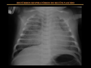DISTÚRBIOS RESPIRATÓRIOS DO RECÉM-NASCIDO 