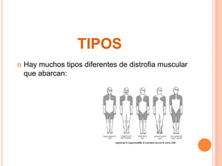 Distrofia muscular | PPTX