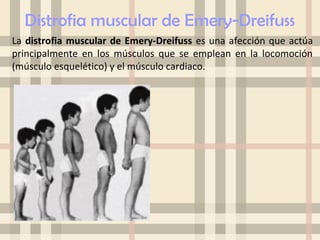 Distrofia muscular | PPT
