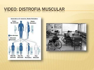 Distrofia muscular | PPTX