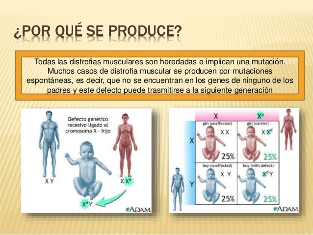 En Que Consiste La Distrofia Muscular