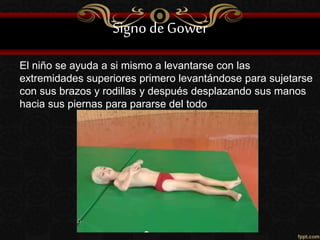 Signo deGower
El niño se ayuda a si mismo a levantarse con las
extremidades superiores primero levantándose para sujetarse
con sus brazos y rodillas y después desplazando sus manos
hacia sus piernas para pararse del todo.
 