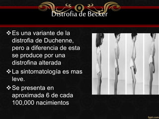 Distrofiade Becker
Es una variante de la
distrofia de Duchenne,
pero a diferencia de esta
se produce por una
distrofina alterada
La sintomatología es mas
leve.
Se presenta en
aproximada 6 de cada
100,000 nacimientos
 