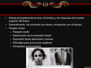 • Afecta principalmente la cara, el hombro y los músculos de la parte
superior del brazo.
• Generalmente los síntomas son leves y empeoran con el tiempo.
• Pueden incluir:
– Parpado caído
– Disminución de la expresión facial
– Expresión facial deprimida o furiosa
– Dificultad para pronunciar palabras
– Omoplatos pronunciados
 