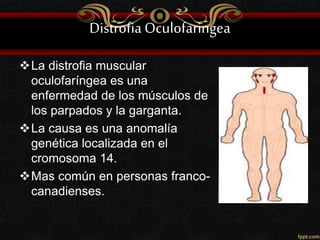 DistrofiaOculofaringea
La distrofia muscular
oculofaríngea es una
enfermedad de los músculos de
los parpados y la garganta.
La causa es una anomalía
genética localizada en el
cromosoma 14.
Mas común en personas franco-
canadienses.
 
