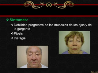 Síntomas:
Debilidad progresiva de los músculos de los ojos y de
la garganta
Ptosis
Disfagia
 
