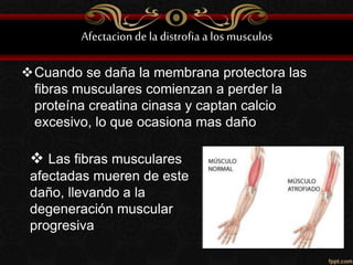 Afectacionde la distrofia a los musculos
Cuando se daña la membrana protectora las
fibras musculares comienzan a perder la
proteína creatina cinasa y captan calcio
excesivo, lo que ocasiona mas daño
 Las fibras musculares
afectadas mueren de este
daño, llevando a la
degeneración muscular
progresiva
 