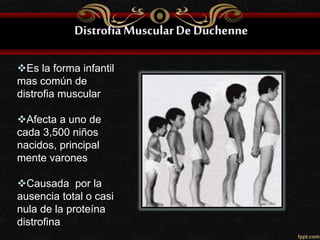 Es la forma infantil
mas común de
distrofia muscular
Afecta a uno de
cada 3,500 niños
nacidos, principal
mente varones
Causada por la
ausencia total o casi
nula de la proteína
distrofina
 