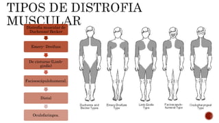 Distrofia muscular | PPTX