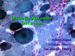 Distrofia Muscular:  Duchenne Ashley Alicea Julianna Nieves Sra. Jessille Rivera 