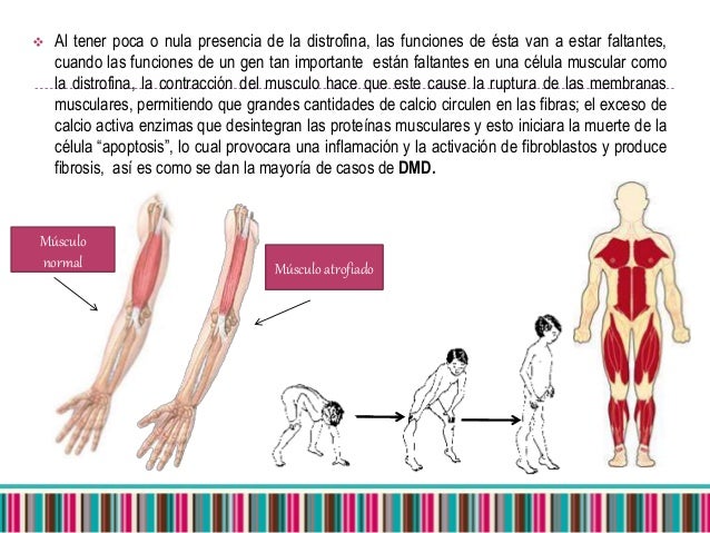 Distrofia muscular de duchenne