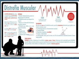 Distrofia muscular de duchenne | PPTX