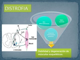 Distrofia muscular de duchenne | PPTX