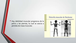 Distrofia muscular de duchenne | PPTX